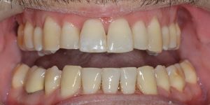 עקירת שיניים קבועות 1
