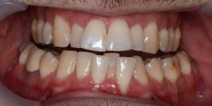 עקירת שיניים קבועות 2