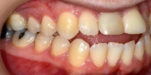 עקירת שיניים קבועות 3