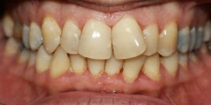 צפיפות שיניים(640x280)