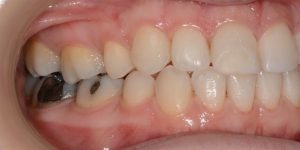 עקירת שיניים קבועות 4